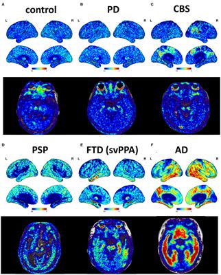 Integrated 18F-T807 Tau PET, Structural MRI, and Plasma Tau in Tauopathy Neurodegenerative Disorders